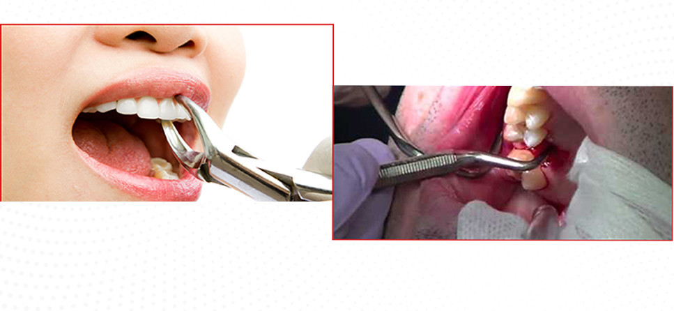 Role of Oral Microorganisms in Dental Caries