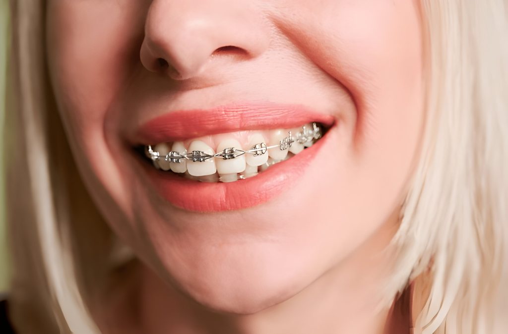 Metal Braces- Cost of Braces in Kathmandu at Happydent Dental Sukedhara, Hattigauda, Kapan  Milanchowk