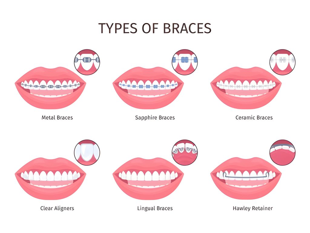 Type of Orthodontic treatment Kathmandu/ Type of Braces in Kathmandu at Happydent Dental clinic 