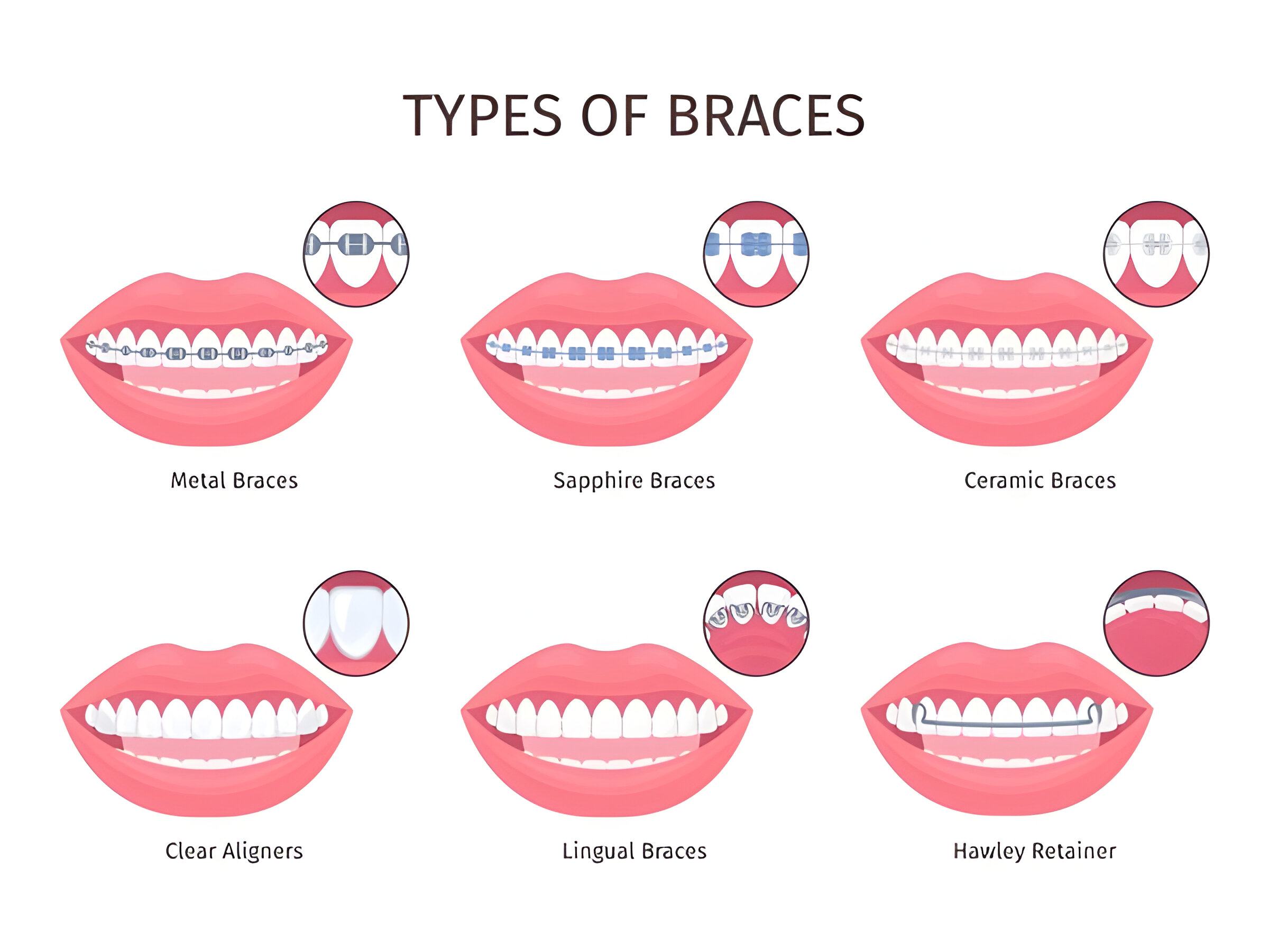 Braces in Kathmandu are Trending Now Among Young Adults: Know the cost of braces in Kathmandu, Nepal