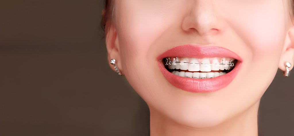 Ceramic Braces- Cost of Braces in Kathmandu at Happydent Dental Sukedhara, Hattigauda, Kapan  Milanchowk