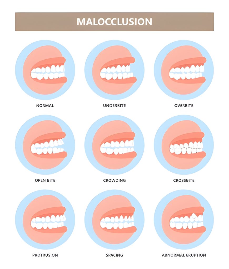 Malocclusion that require orthodontic treatment kathmandu at Happydent Dental 