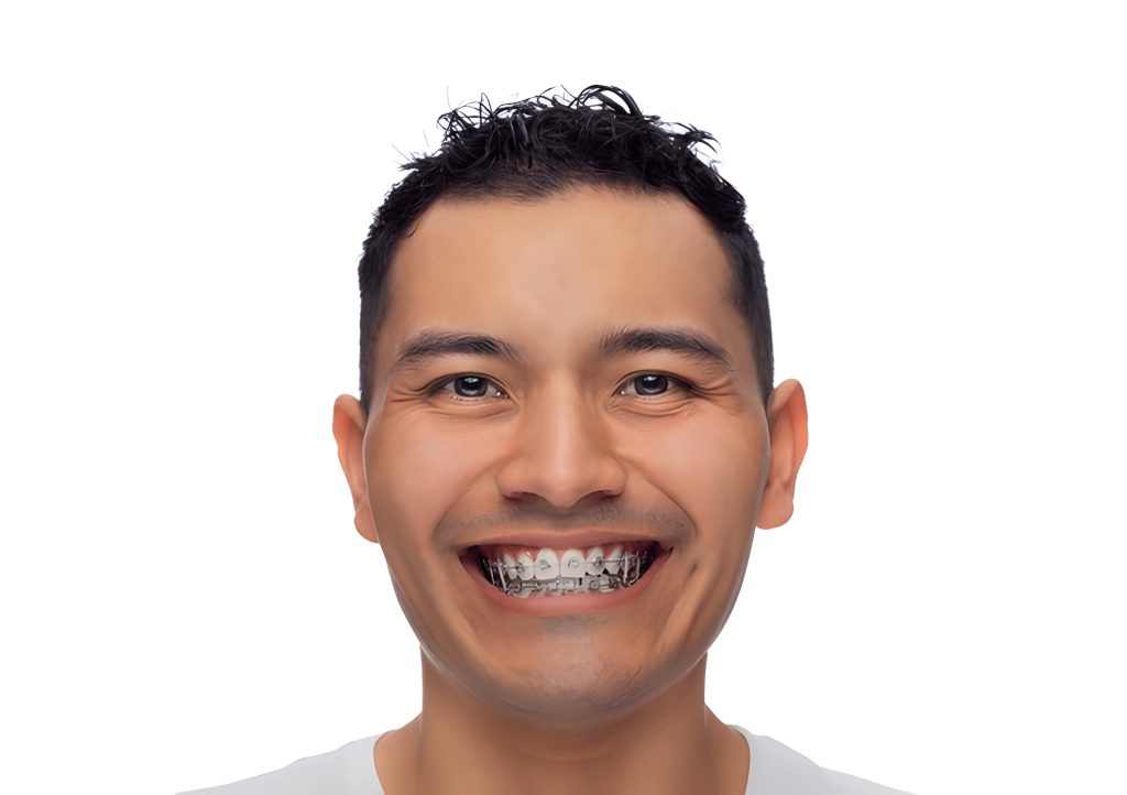 Best Orthodontic Treatment Kathmandu with Metal Braces at Happydent Dental Kathmandu