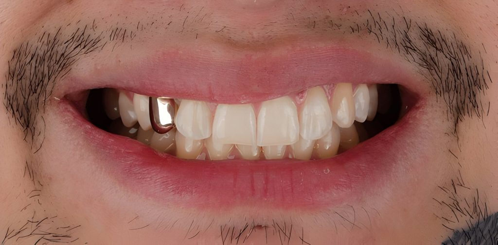 Gold Tooth Crown Price in Kathmandu at Happydent Dental CLinic 