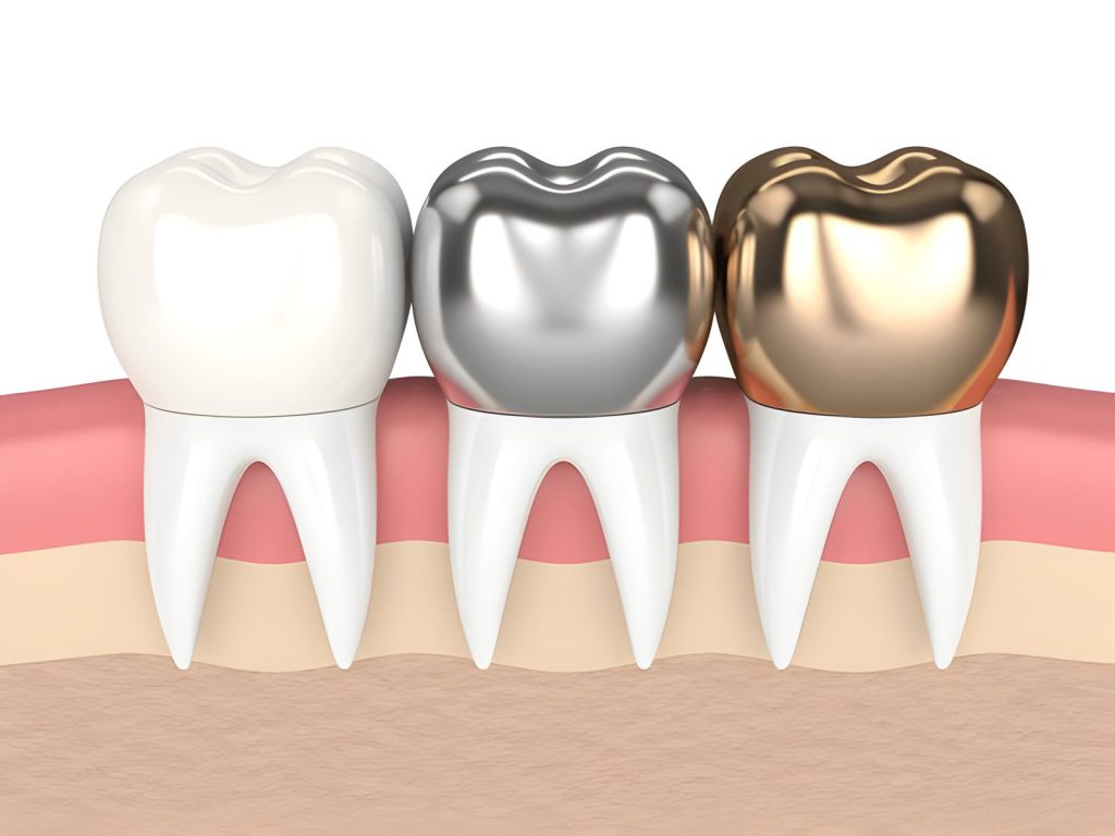 Metal Tooth Crown Price in Kathmandu at Happydent Dental CLinic 